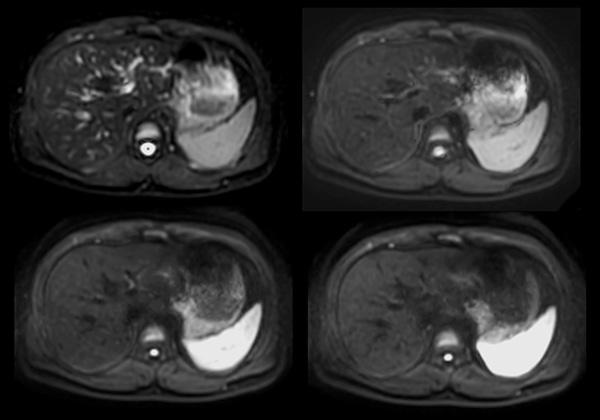Axial Diffusion (b0, 100, 300, 600)