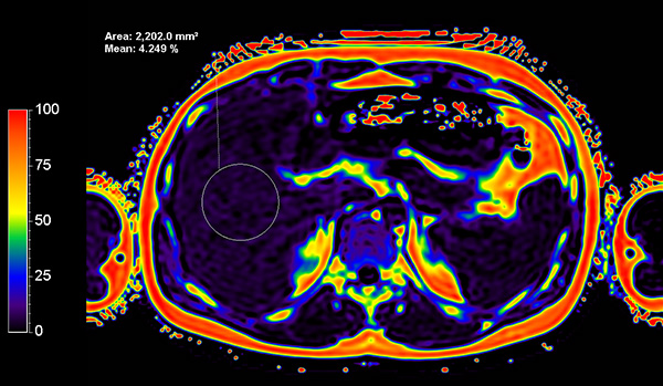 Axial mDIXON Quant (Fat Fraction)
