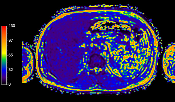 Axial mDIXON Quant (T2*)