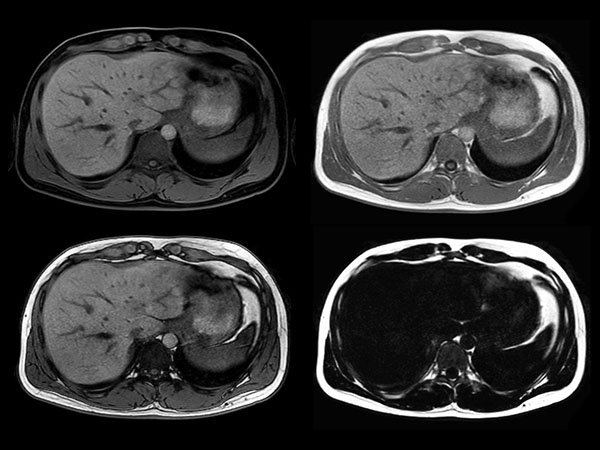 Axial mDIXON (W, IP, OP, F)