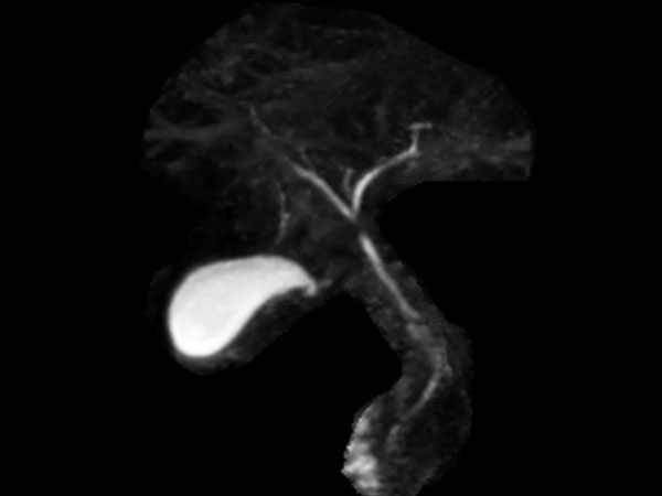 3D MRCP (MIP)