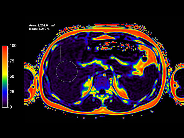 Axial mDIXON Quant (Fat Fraction)