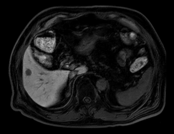 Axial mDIXON (Water)