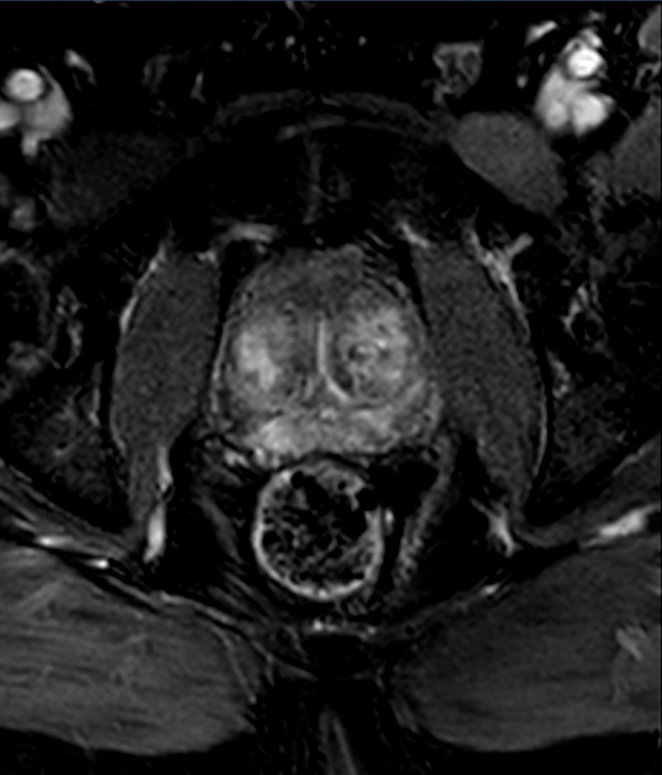 Axial dynamic mDIXON FFE