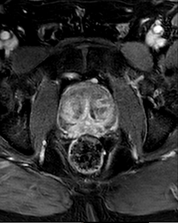 Axial dynamic mDIXON FFE