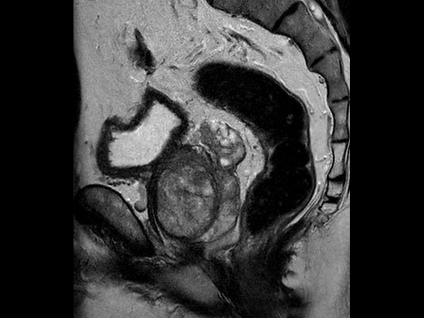 Sagittal T2w TSE