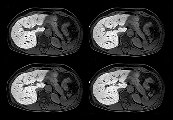 Axial post-gado 3D T1w TFE