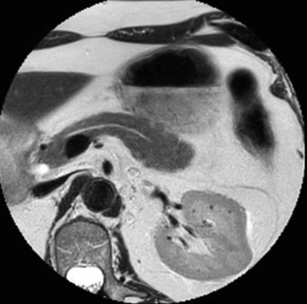 Axial T2w MultiVane XD