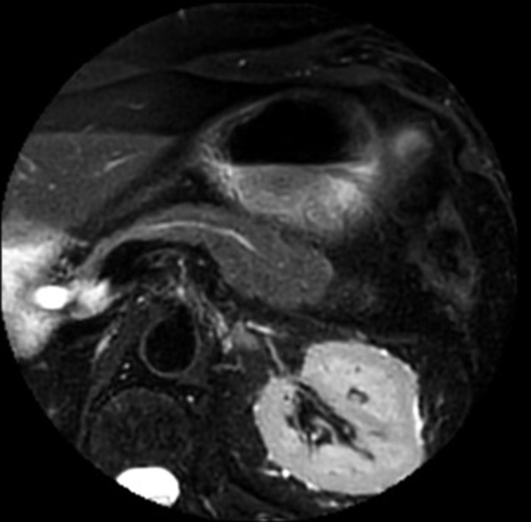 Axial T2w SPIR MultiVane XD