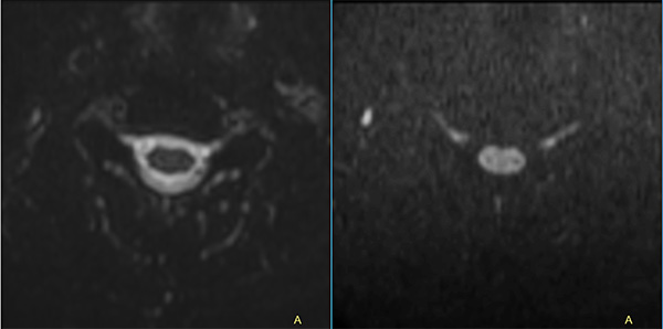 Axial dS Zoom DWI (b0, b600)