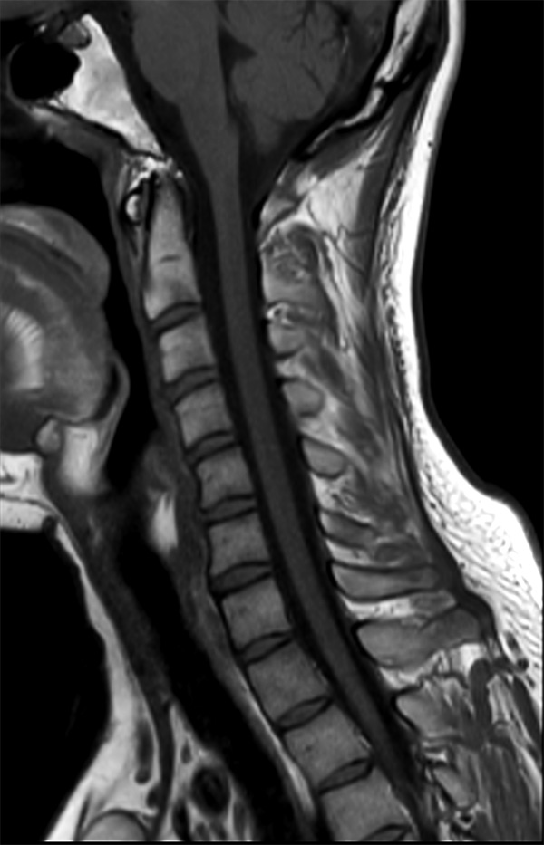 Sagittal T1w TSE