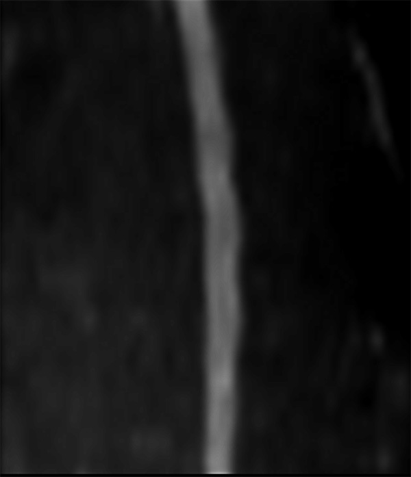 dS Zoom DWI (b600, sagittal reformat)