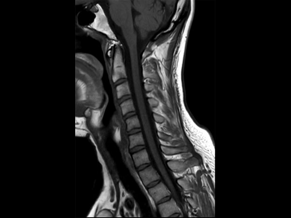 Sagittal T1w TSE