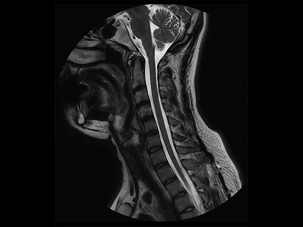 Sagittal T2w MultiVane XD