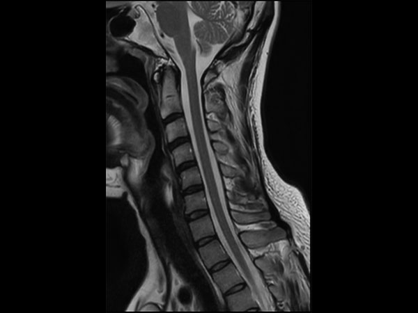 Sagittal T2w TSE