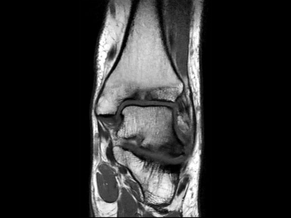 Coronal T1w TSE