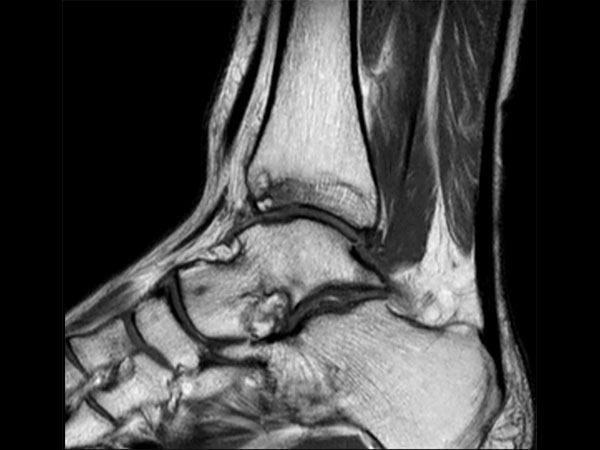 Sagittal PDW TSE