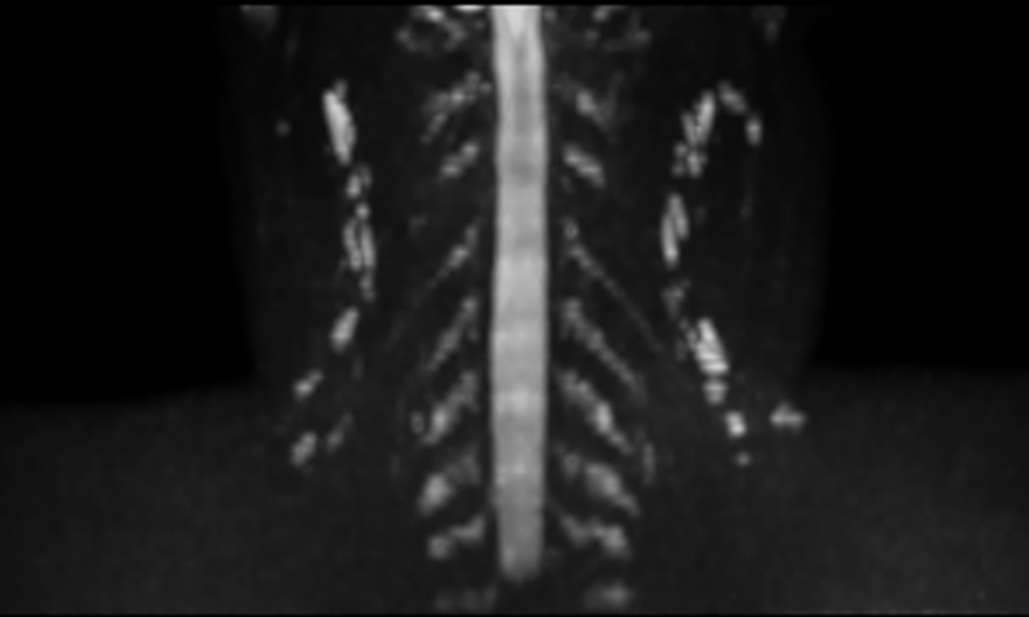 DWI (b600, coronal reformat)