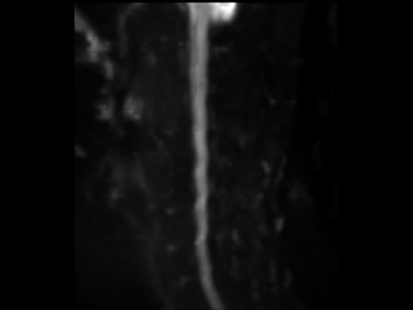 DWI (b600, sagittal reformat)