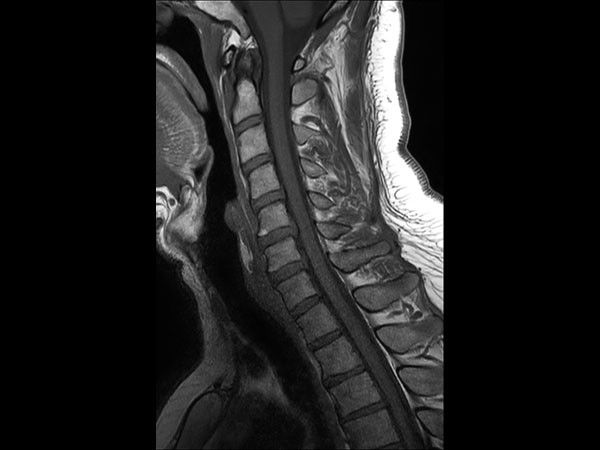 Sagittal T1w TSE