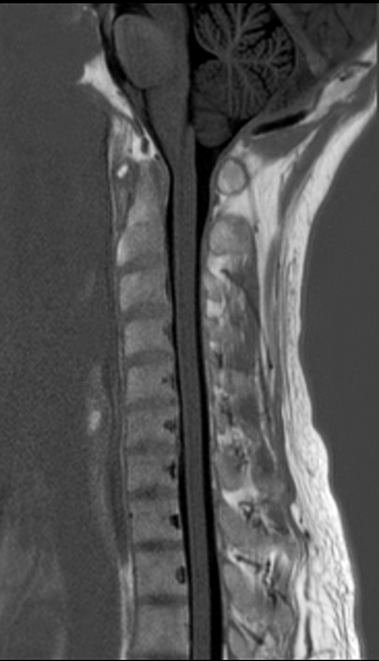 Sagittal IR TSE