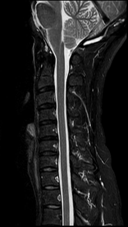 Sagittal STIR TSE