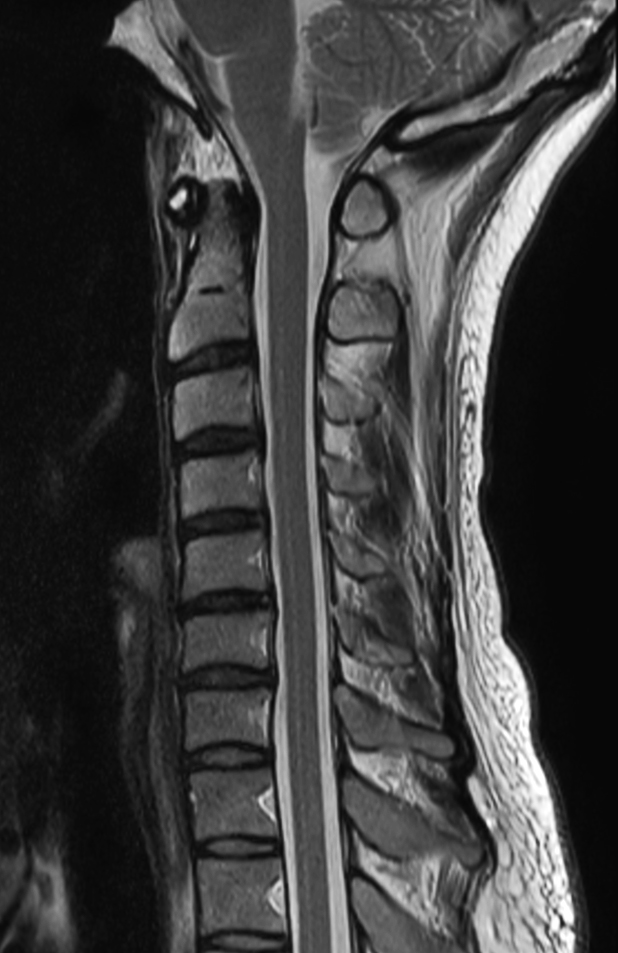 Sagittal T2w TSE