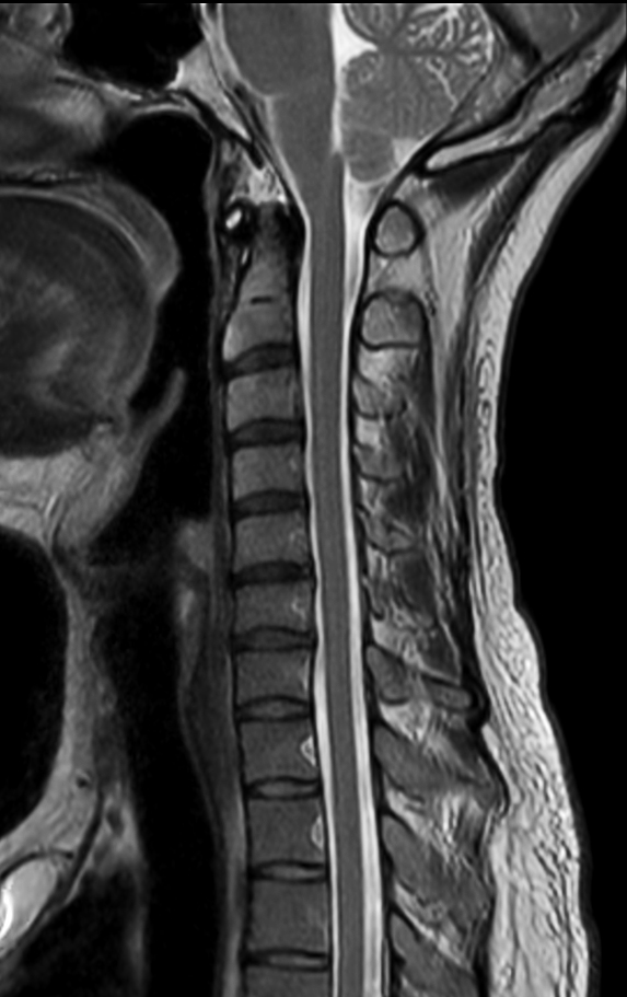 Sagittal T2w mDIXON TSE (In Phase)