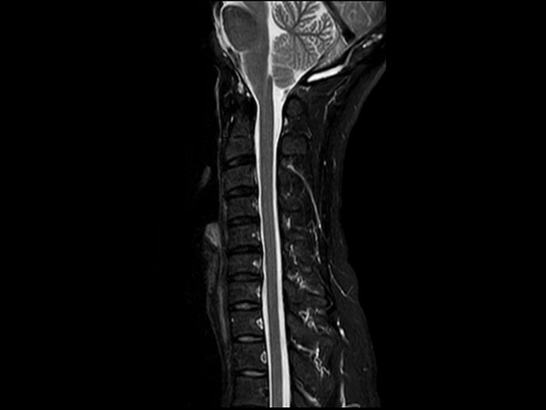 Sagittal STIR TSE