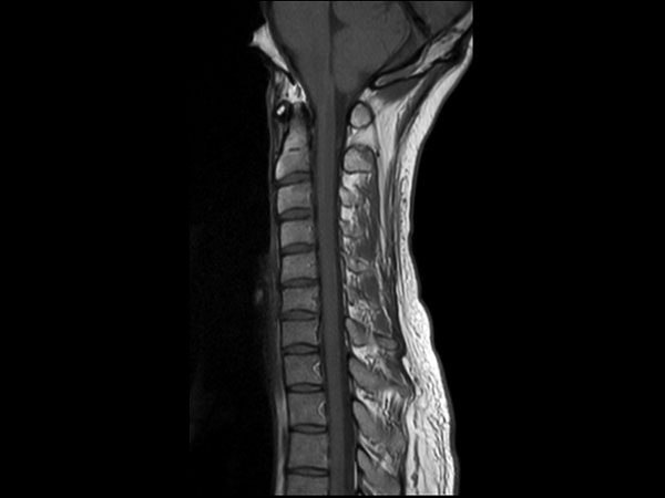 Sagittal T1w mDIXON TSE (In Phase)