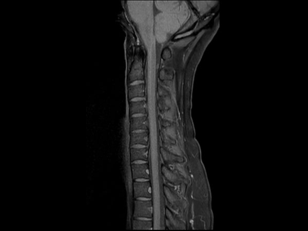 Sagittal T1w mDIXON TSE (Water)