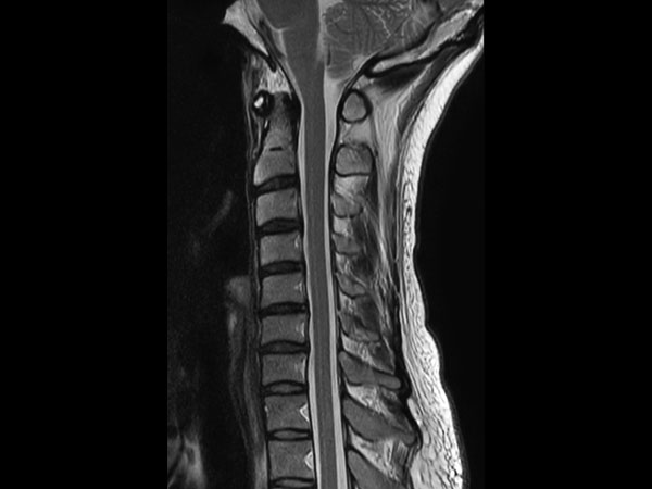 Sagittal T2w TSE