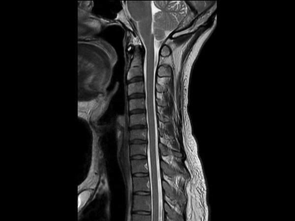 Sagittal T2w mDIXON TSE (In Phase)