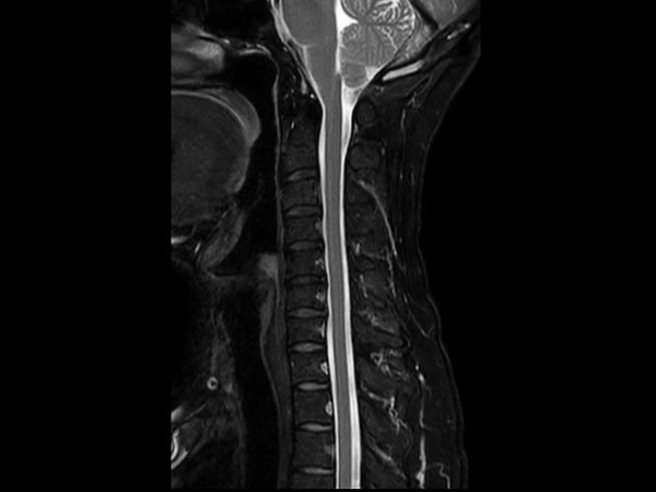 Sagittal T2w mDIXON TSE (Water)