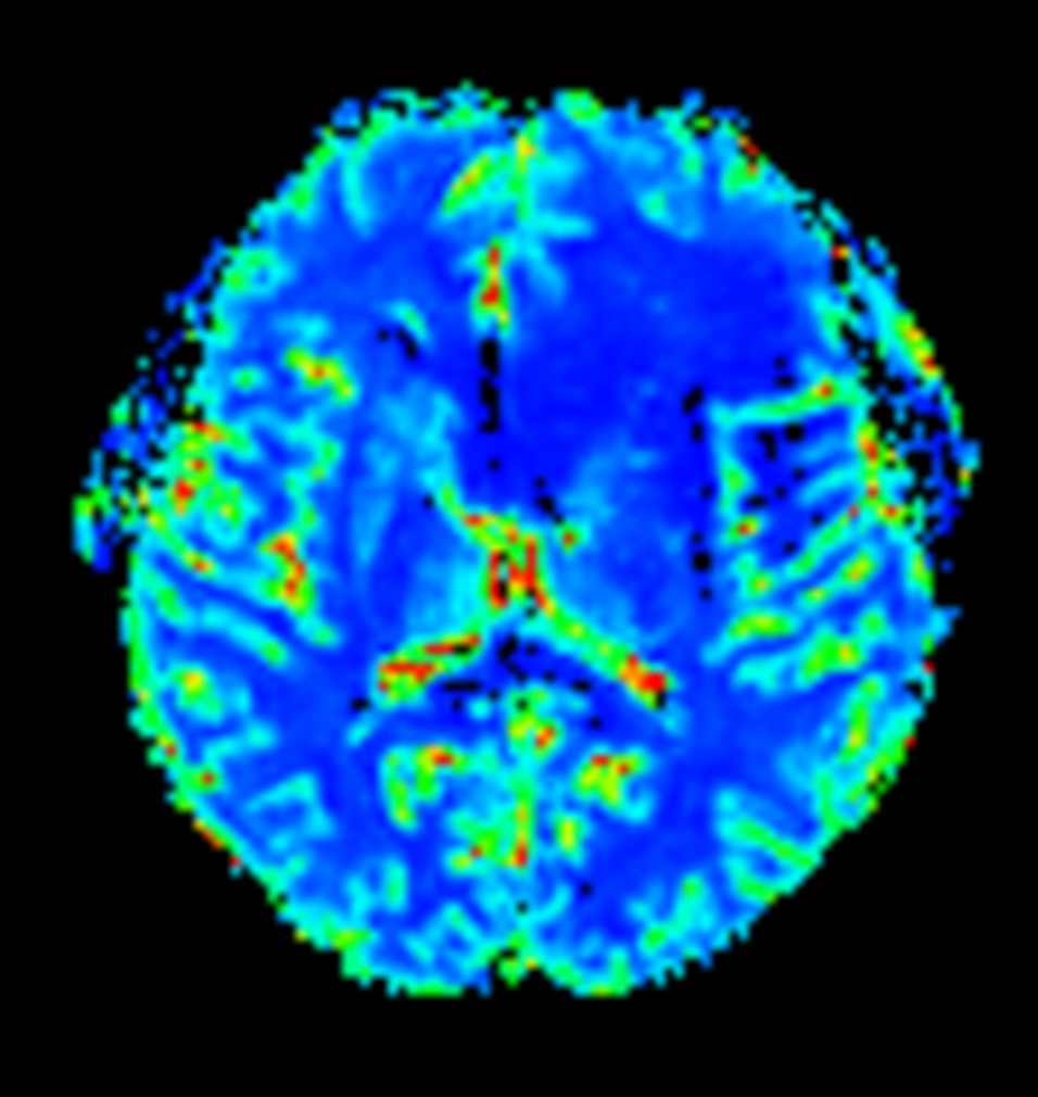 T2* Perfusion (Index)