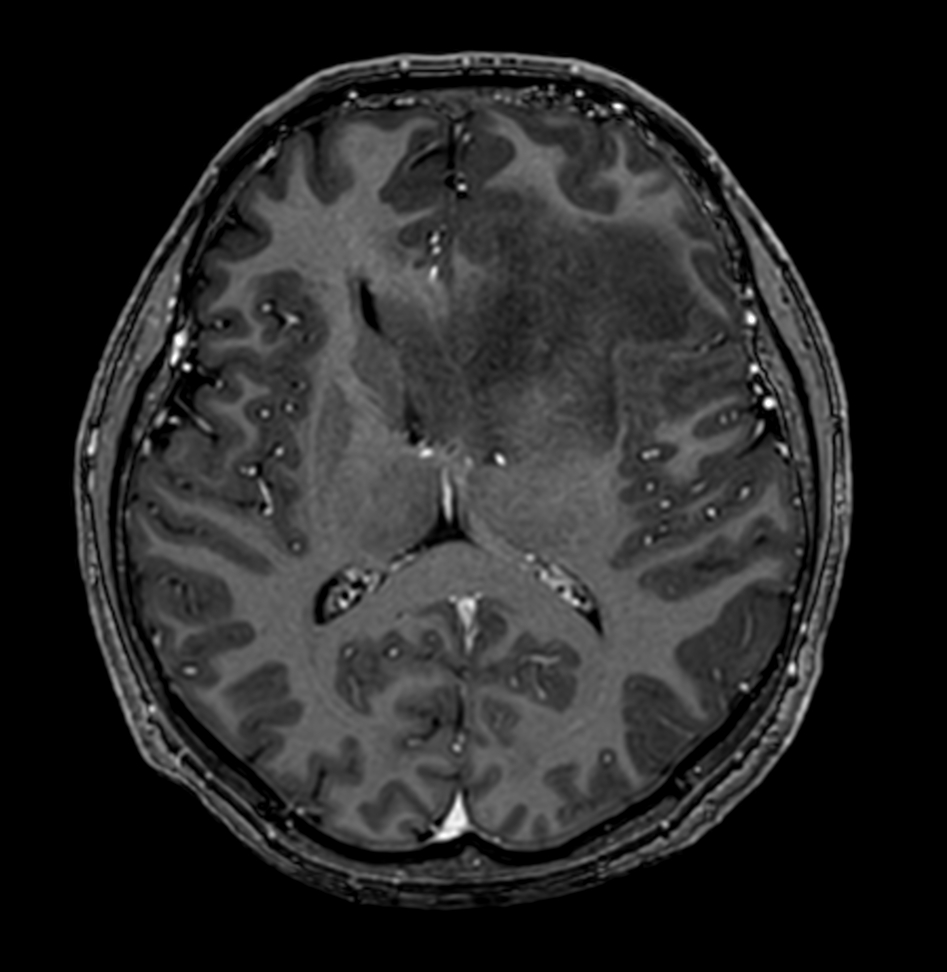 3D T1w TFE - Post-gado