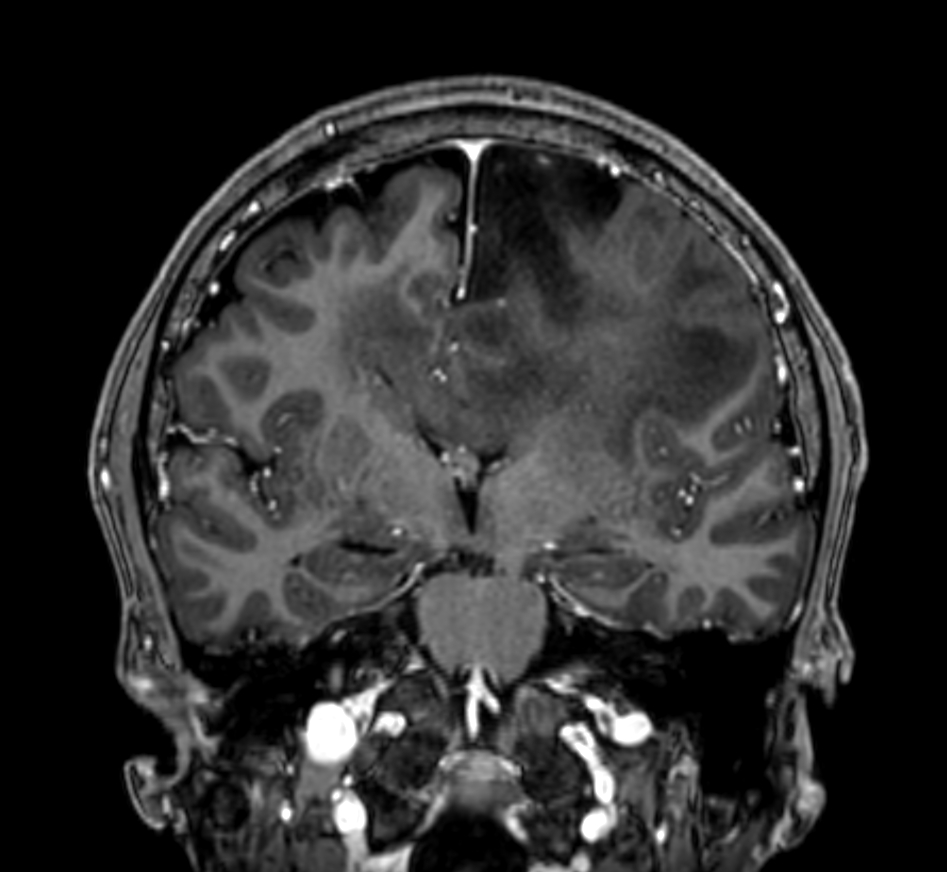 3D T1w TFE - Post-gado (coronal reformat)