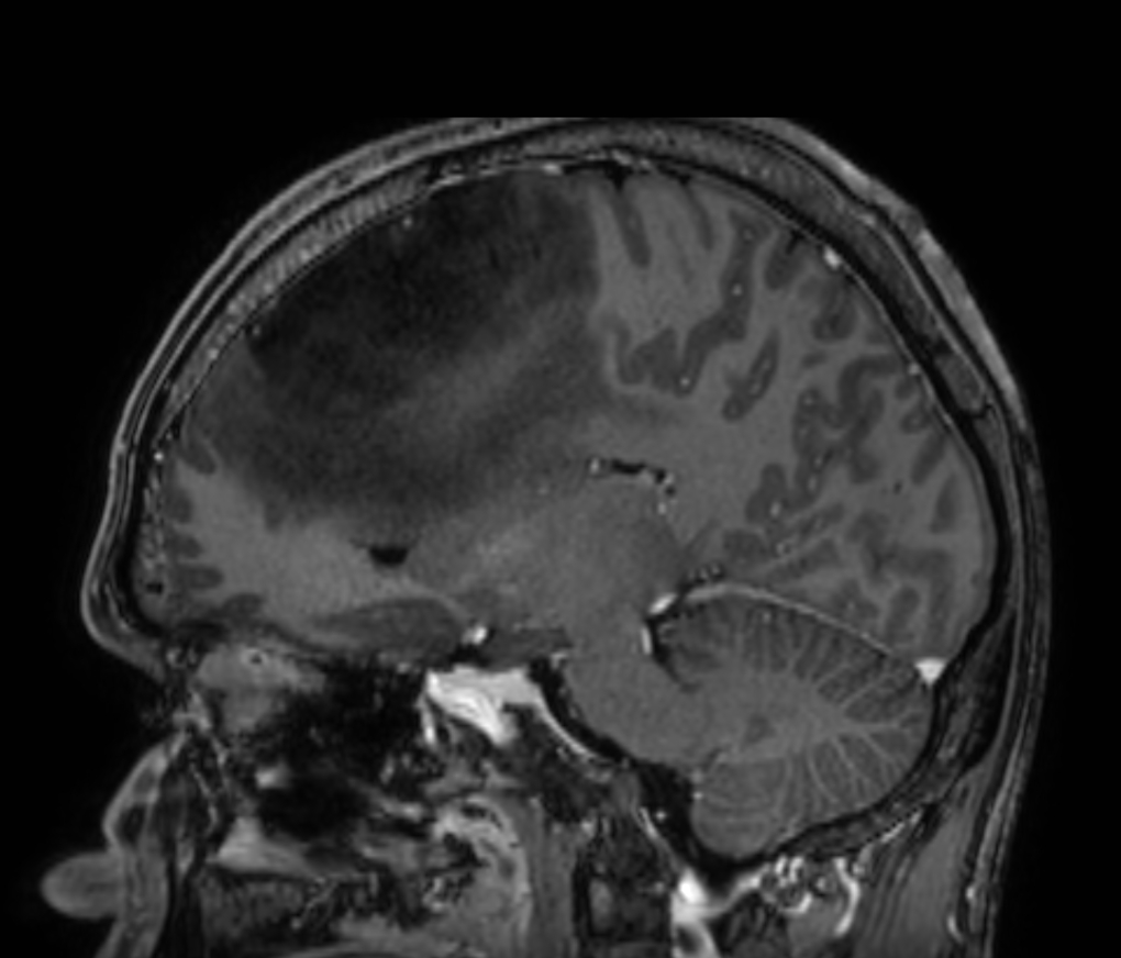 3D T1w TFE - Post-gado (sagittal reformat)