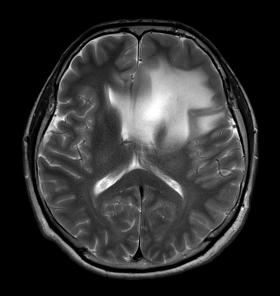 T2w TSE - MultiVane XD