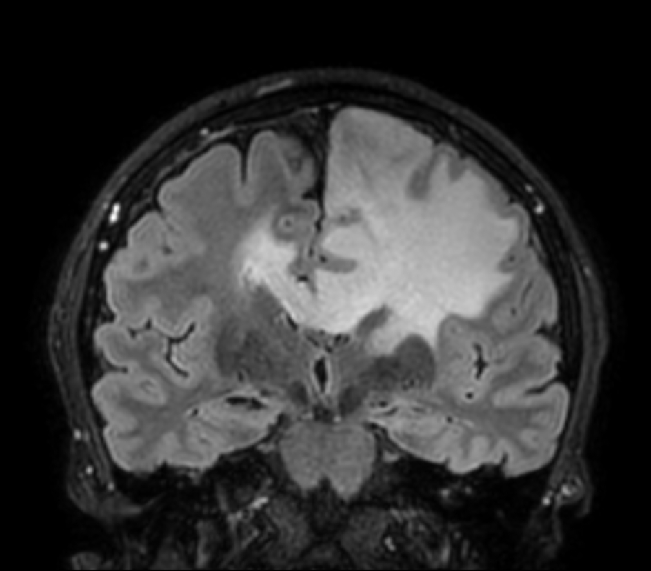 3D VIEW - T2w FLAIR (coronal reformat)