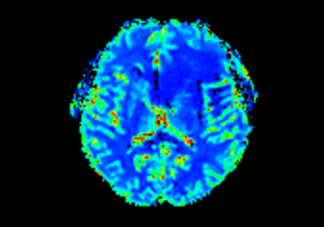 T2* Perfusion (Index)