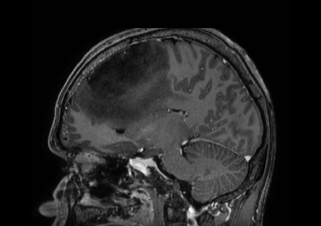 3D T1w TFE - Post-gado (sagittal reformat)