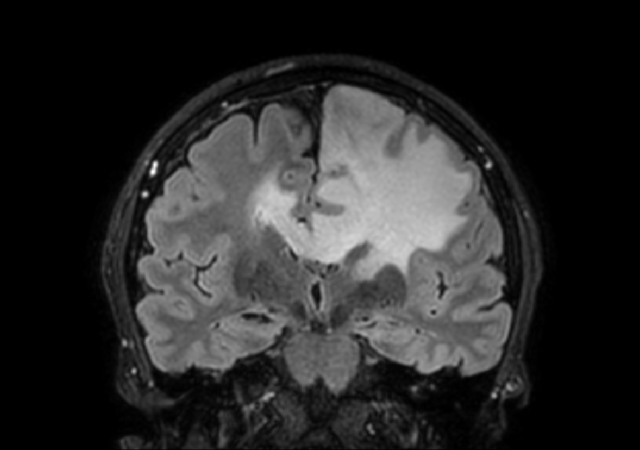 3D VIEW - T2w FLAIR (coronal reformat)