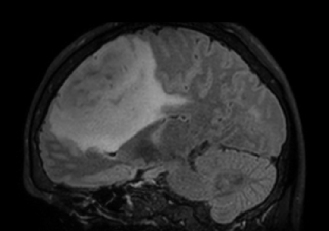 3D VIEW - T2w FLAIR (sagittal reformat)