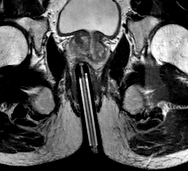 Axial T2w TSE Biopsy Needle Check