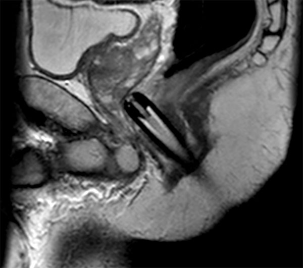 Sagittal T2w TSE Biopsy Needle Check