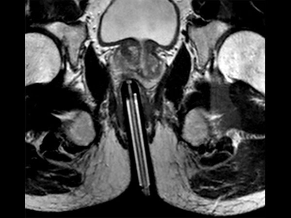 Axial T2w TSE Biopsy Needle Check