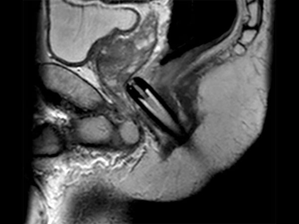 Sagittal T2w TSE Biopsy Needle Check