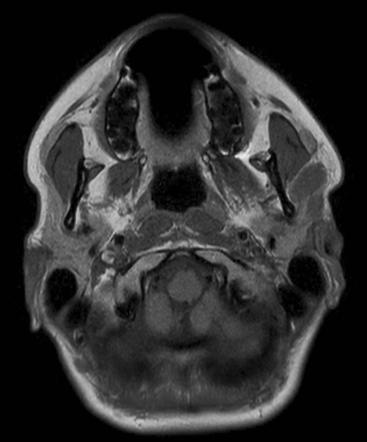 Axial T1w  mDIXON TSE (In Phase)