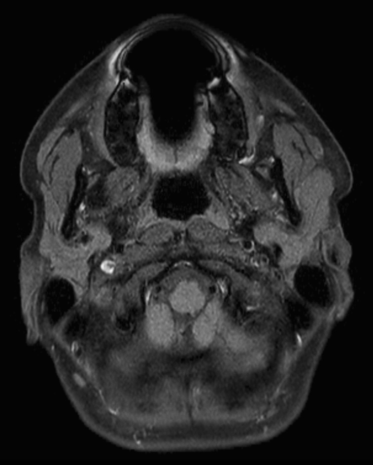 Axial T1w  mDIXON TSE (Water)